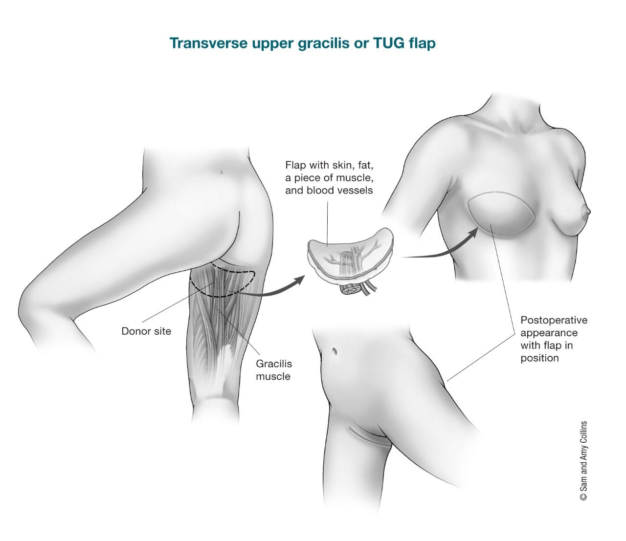 Stage C Autologous Breast Reconstruction – Medical Stock Images Company