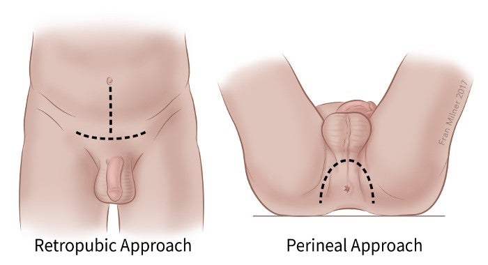 Surgery for Prostate Cancer Prostatectomy American Cancer Society