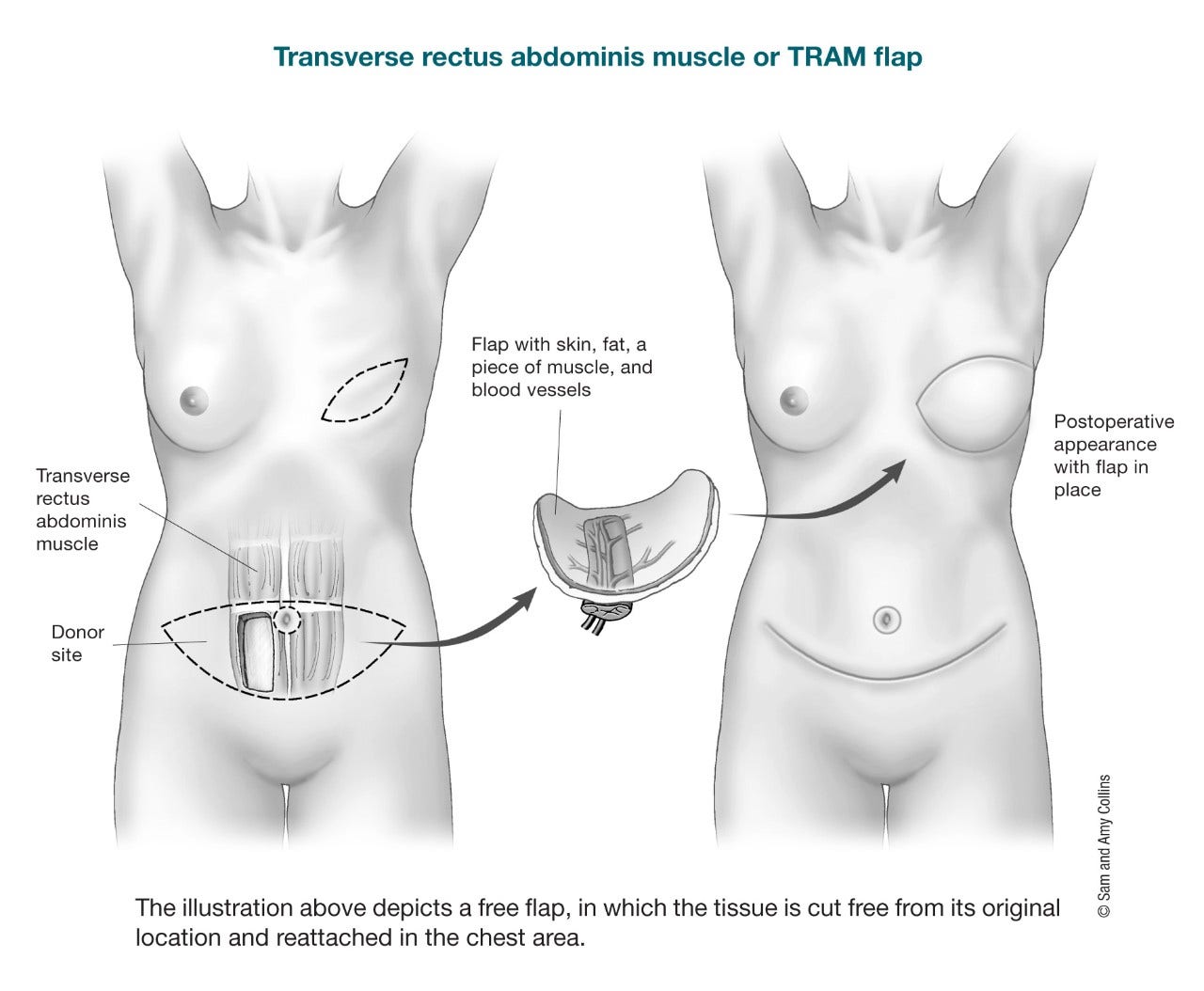 Flap Procedures, Breast Reconstruction Using Your Own Tissue