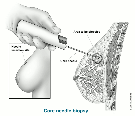 Core Needle Biopsy of the Breast, Stereotactic Breast Biopsy