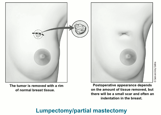 Breast-conserving Surgery (Lumpectomy)
