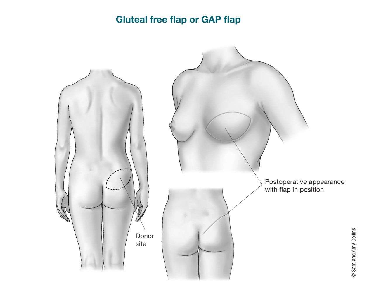Flap Procedures  Breast Reconstruction Using Your Own Tissue
