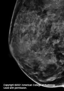 Mammogram x-ray of a breast with extremely dense tissue, showing mostly white, making it hard to see tumors in the tissue.