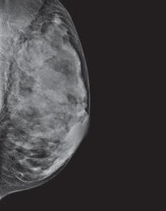 40% of Women Have a Dense Breast Tissue - Mica