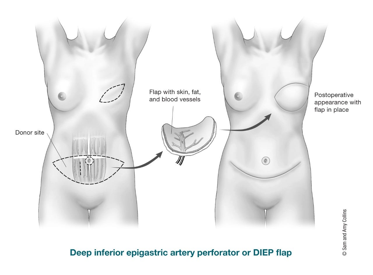 Postoperative view after bilateral prophylactic mastectomy and