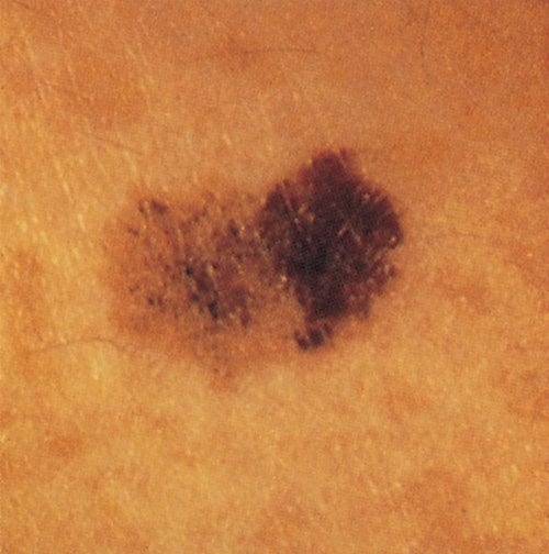 Spots and Dots: Identifying Skin Cancer and Liver Spots