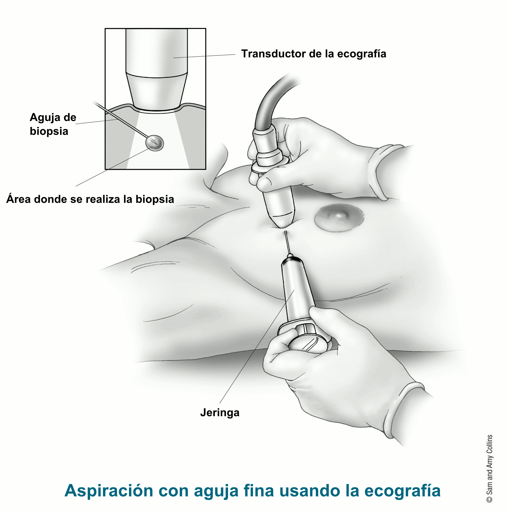 Biopsia Por Aspiración Con Aguja Fina