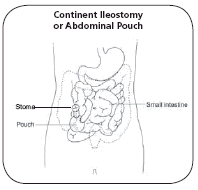 Ileostomy Types | American Cancer Society