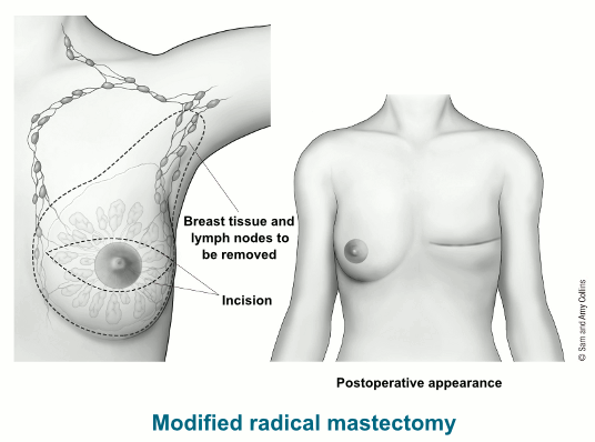 What is a Mastectomy?  American Cancer Society