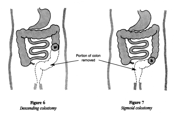 illustration showing the portion of the colon removed for a descending colostomy and a sigmoid colostomy