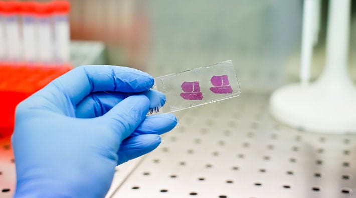 A hand in a blue glove holds a slide with a tissue sample 