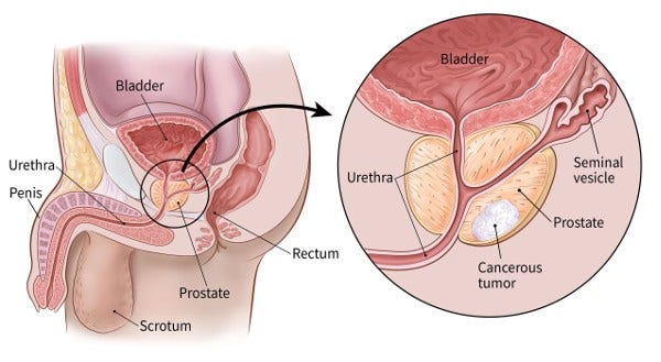 If You Have Prostate Cancer, Prostate Cancer Guide