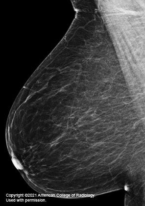 Mammogram x-ray showing a breast that is almost all fatty tissue, which does not show up on x-ray, making tumors easier to spot.