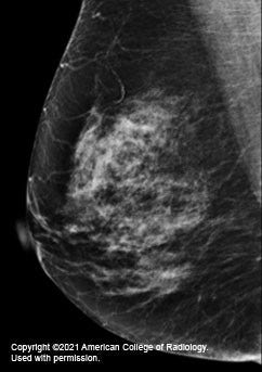 Mammogram x-ray of a breast with more dense glandular and fibrous tissue, which shows white on x-ray, making it harder to see tumors in or near the dense areas.