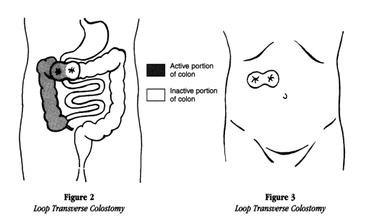 A) Illustrates functional loop ileostomy with stoma bag applied over