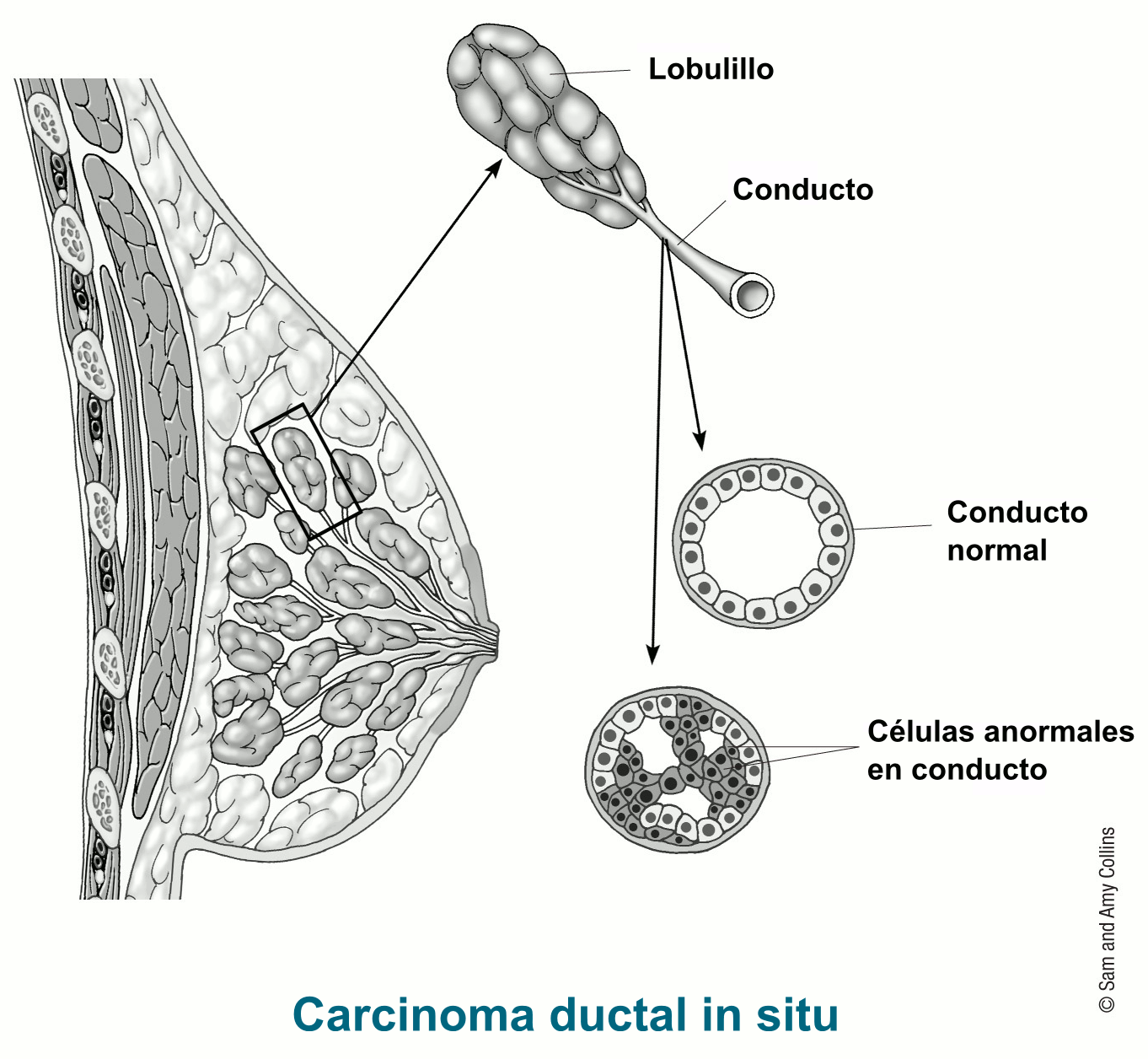 Carcinoma Ductal In Situ | American Cancer Society