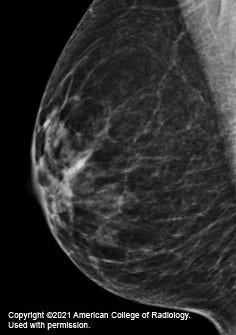 Mammogram x-ray of breast with scattered areas of dense glandular and fibrous tissue that shows up white on x-ray.