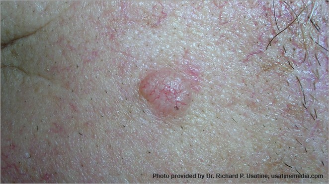 skin cancer spots