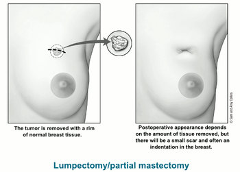 Indent Girl S Video Xxx - Breast-conserving Surgery (Lumpectomy) | Treating Breast Cancer