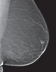 Breast Density And Mammogram Reports Dense Breast Tissue