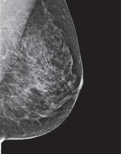 Breast Density And Mammogram Reports Dense Breast Tissue