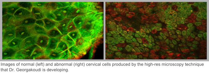 normal and abnormal cervical cells